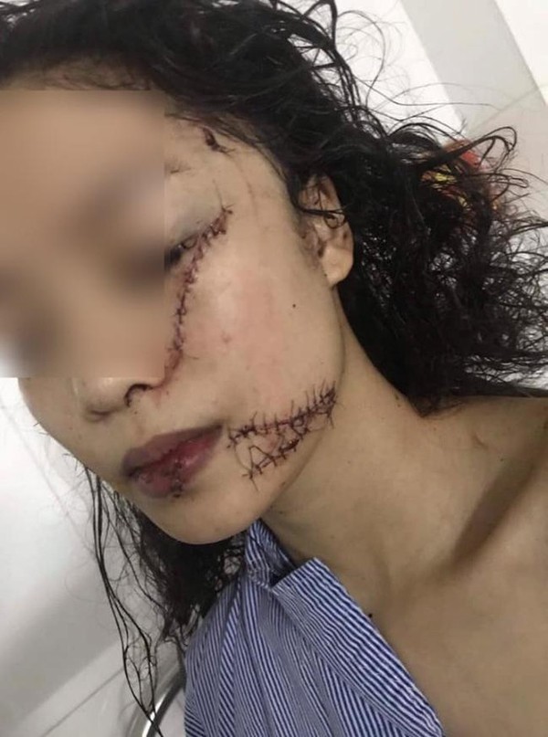 Cô gái xinh đẹp bị rạch mặt, cổ và tay, phải khâu 60 mũi: Nghi vấn bị bạn thân dụ tới phòng?