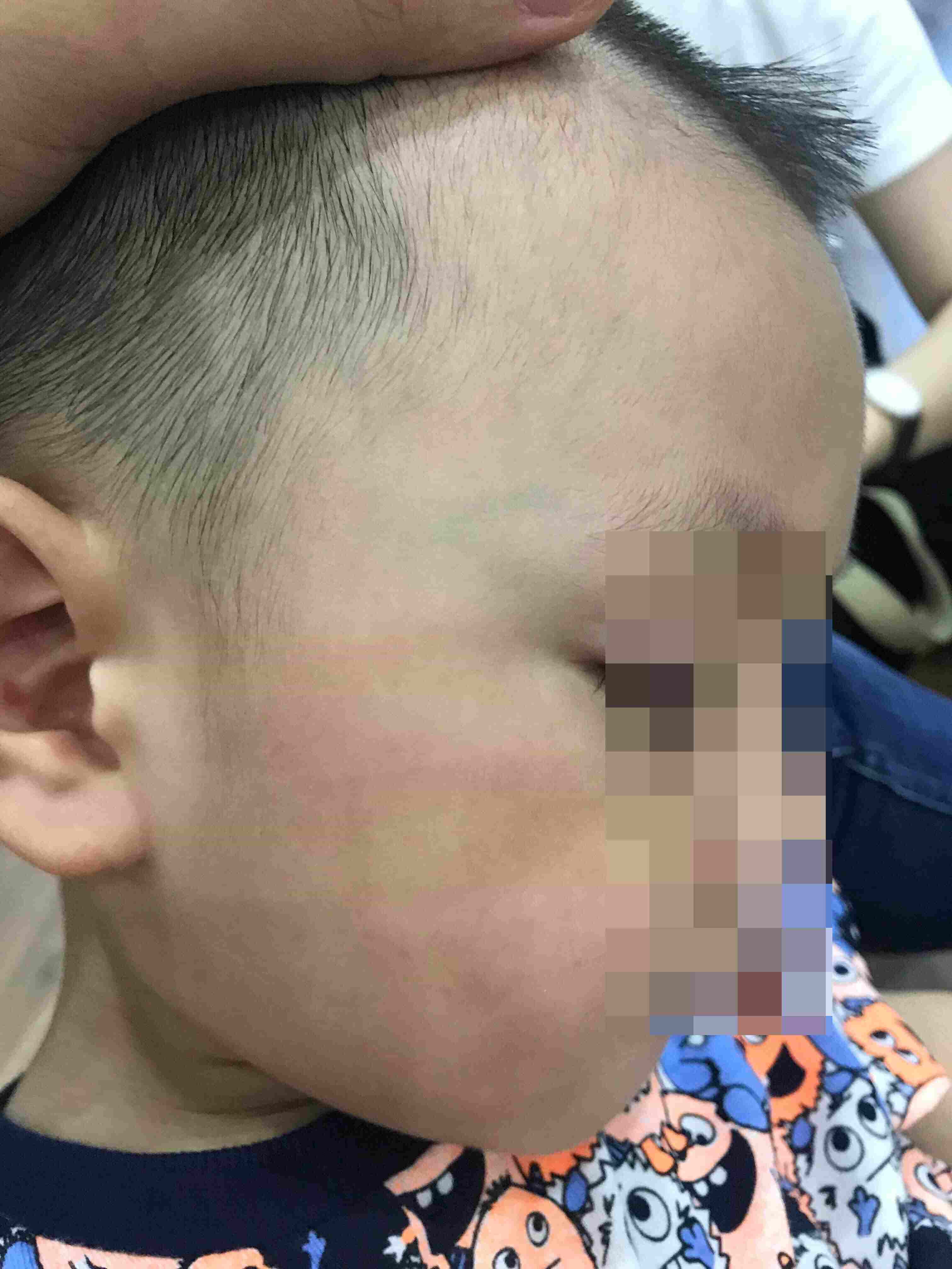 Cô giáo tát bé 3 tuổi bầm mặt, tụ máu môi